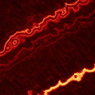 Antibiotic stained tooth