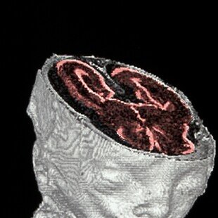 Foetal MRI scan