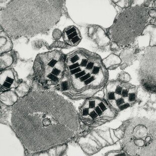 Mitochondrial inclusions in muscle biopsy