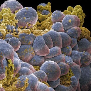 Breast cancer cells