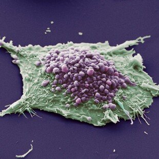 Lung cancer cell