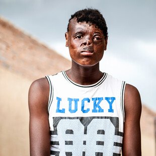 Portrait of a teenage boy severely burned when he was one month old